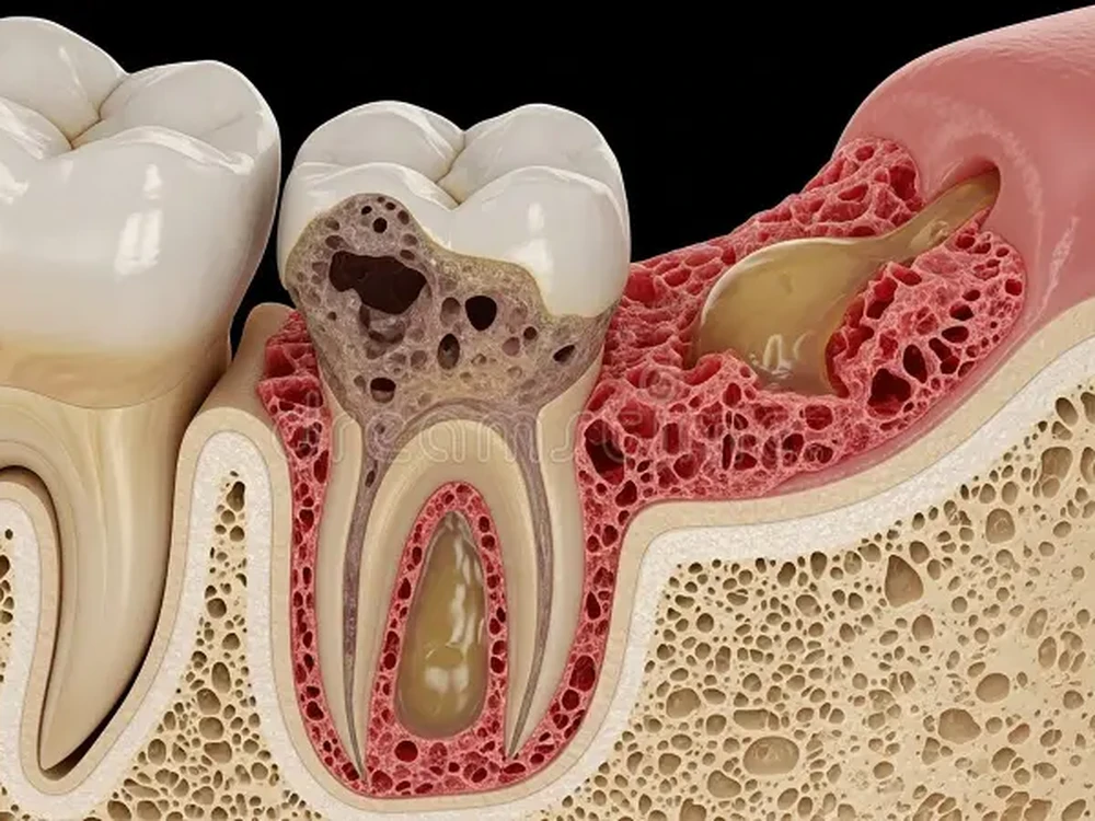 3D anatomical illustration showing jawbone erosion and infection around a tooth root