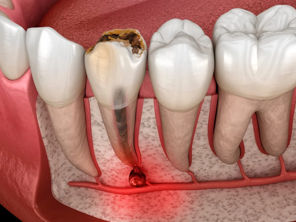 3D anatomical illustration of a dental abscess — a pocket of infection glowing at the root tip of a tooth