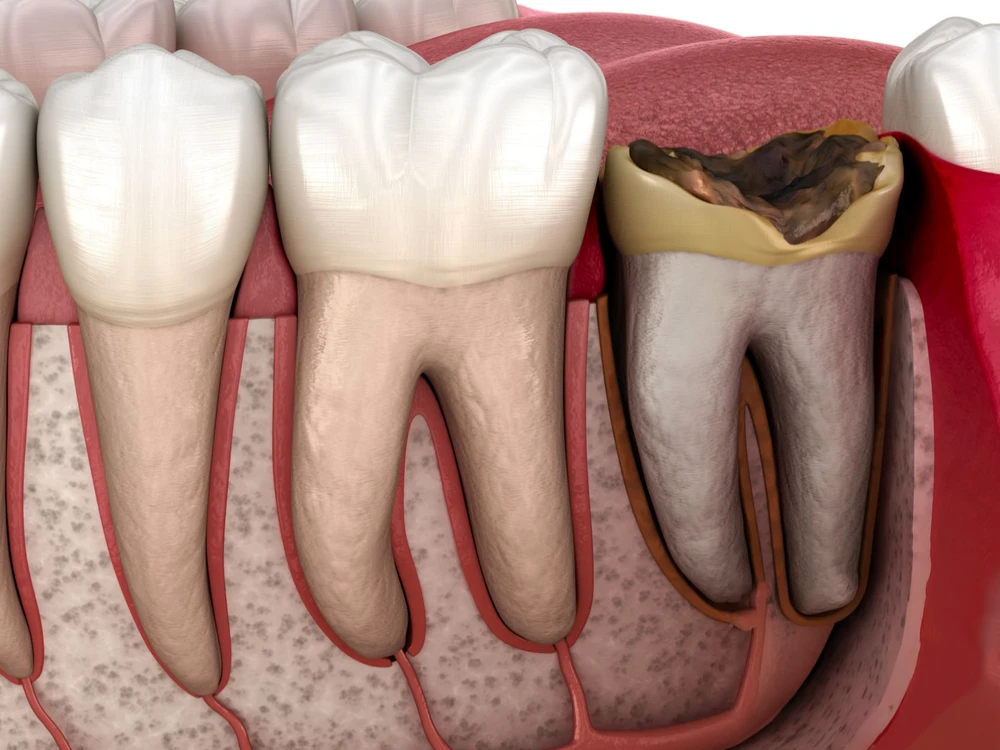 3D anatomical illustration comparing a healthy tooth root to a severely decayed, structurally compromised tooth root