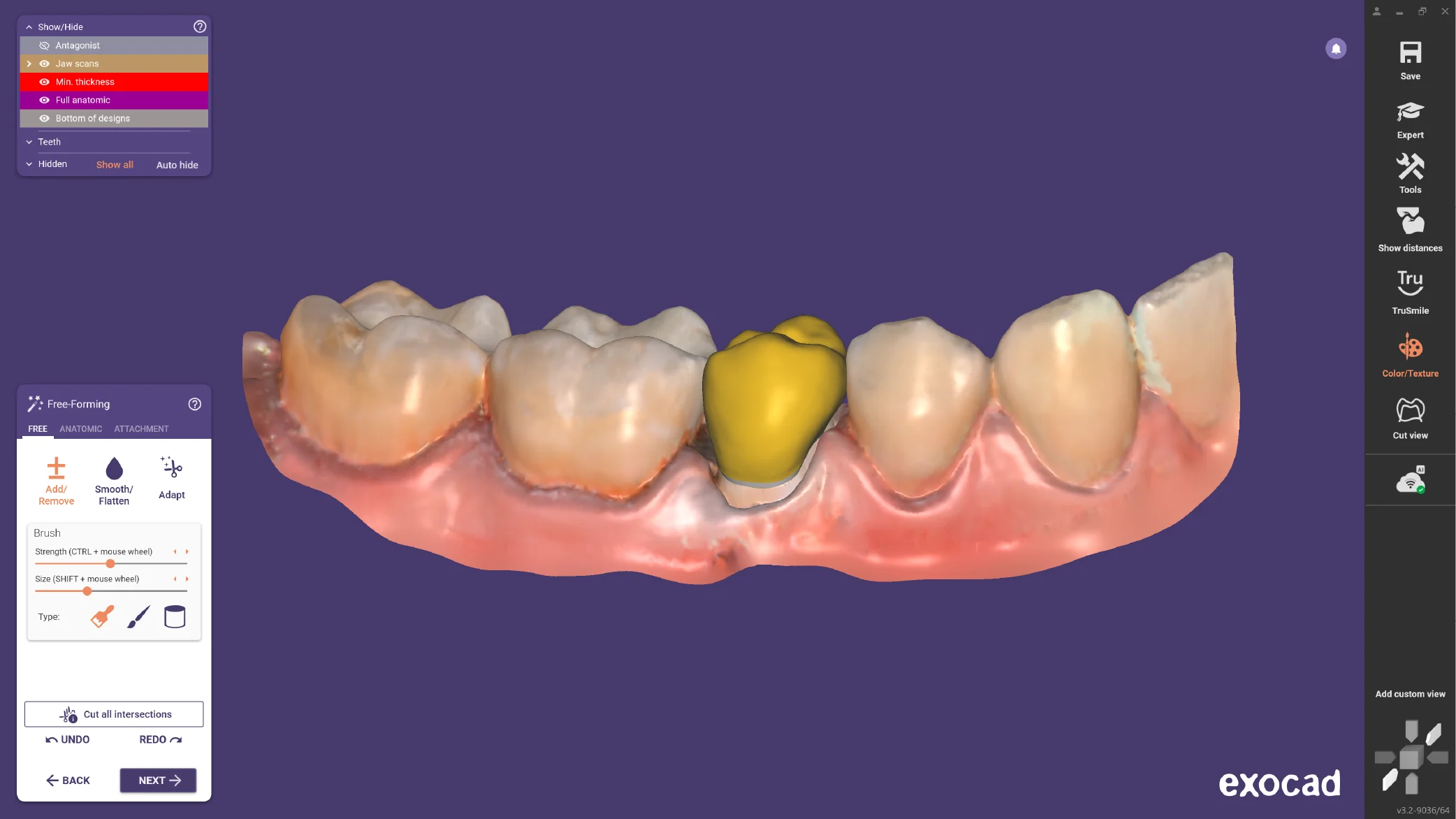 Exocad CAD software showing 3D crown design over digital jaw scan