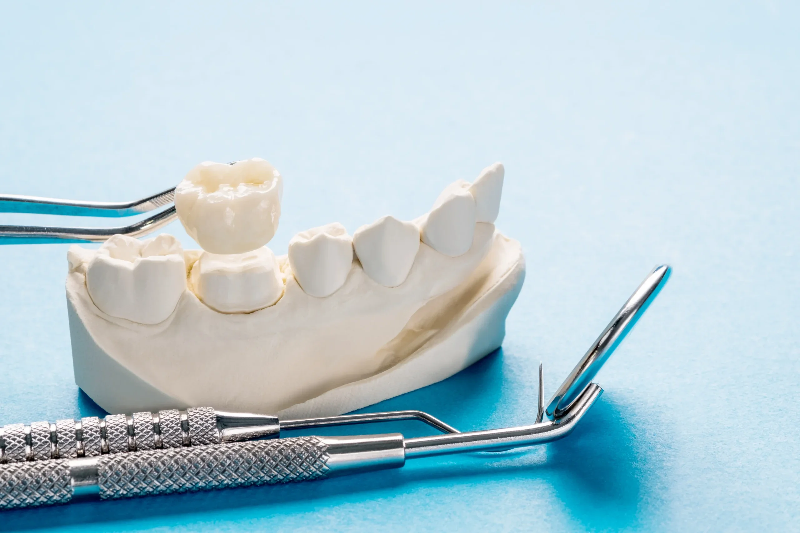 Dental crown being placed on tooth model