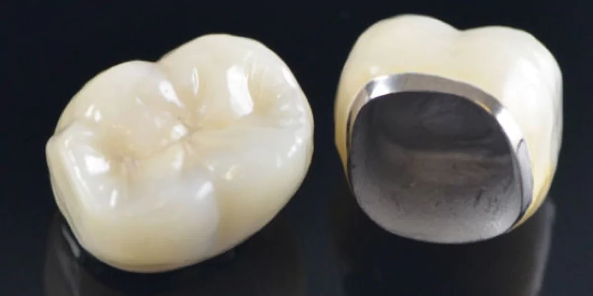 PFM crown showing porcelain exterior and metal base interior