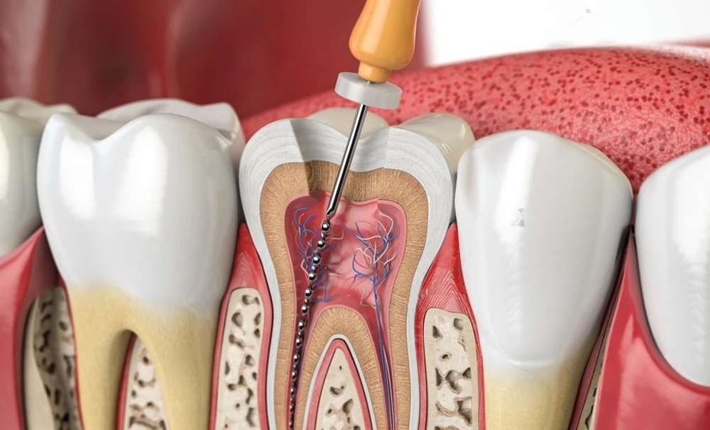 Illustration of an endodontic file inside a tooth's root canal during treatment