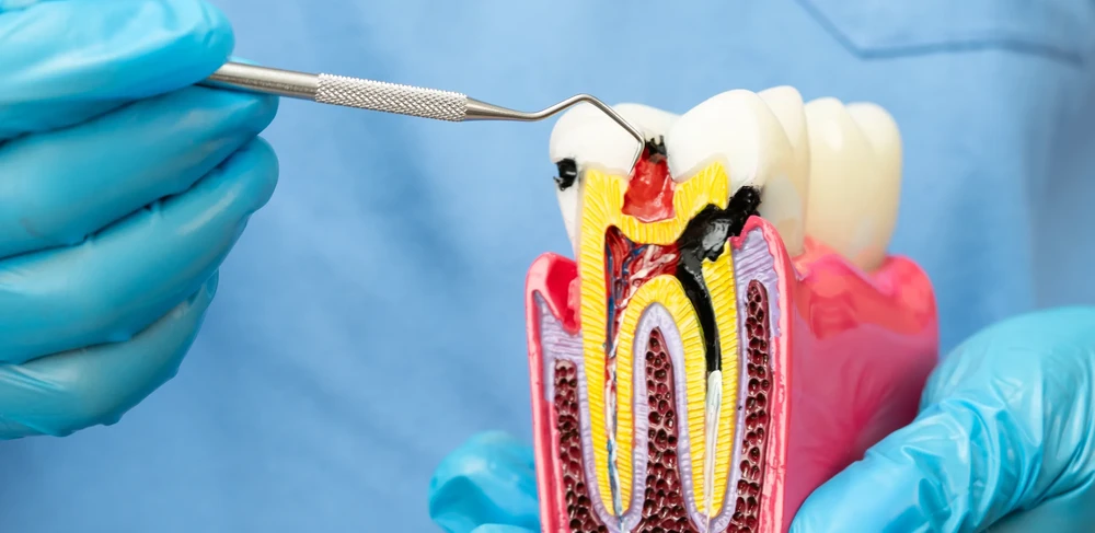 Dentist examining a cross-section model of a tooth showing the infected pulp chamber and root canal system