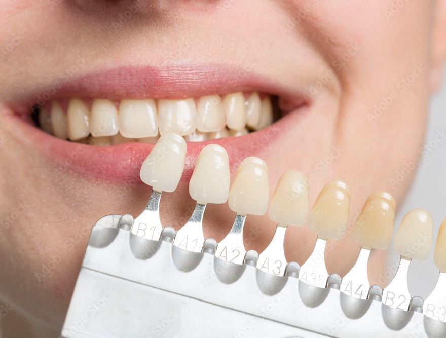 Shade guide being matched against patient's natural teeth for accurate crown colour selection