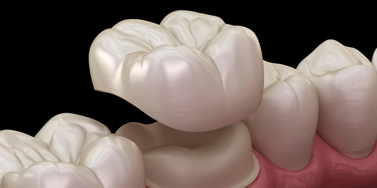 Full zirconia crown showing translucent ceramic with no metal base
